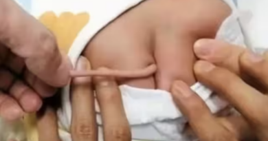 a boy born with a tail in a rare Viral News case