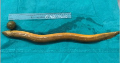 Indian man in Vietnam inserts live eel up his rectum as a sex toy