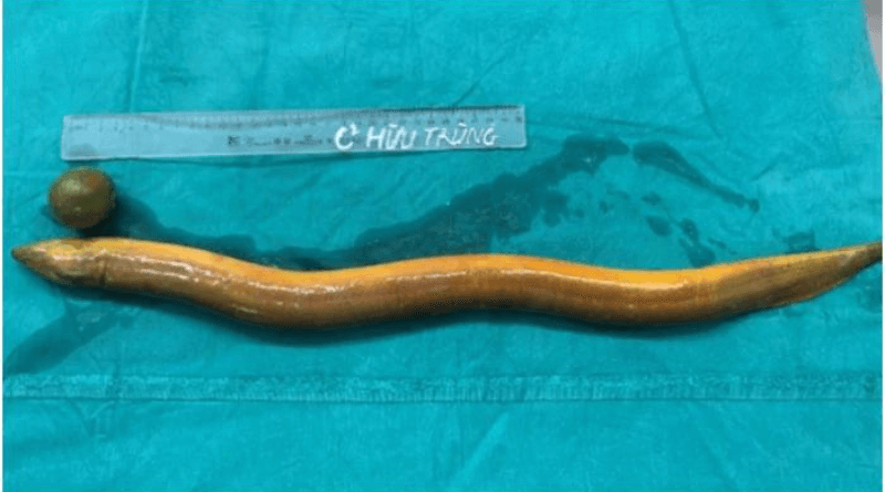 Indian man in Vietnam inserts live eel up his rectum as a sex toy